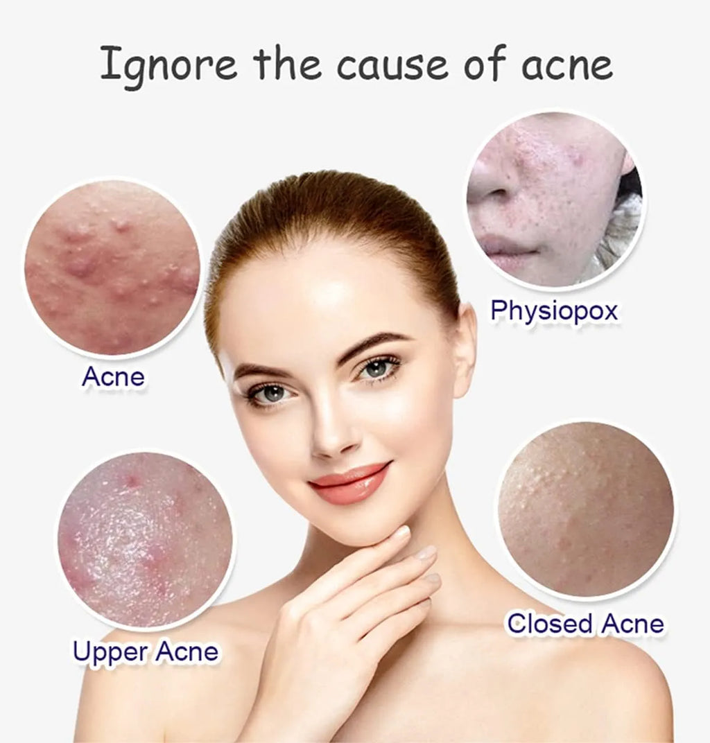 Aichun Beauty Anti-Acne Whitening Facial Serum – 30ml