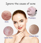 Aichun Beauty Anti-Acne Whitening Facial Serum – 30ml